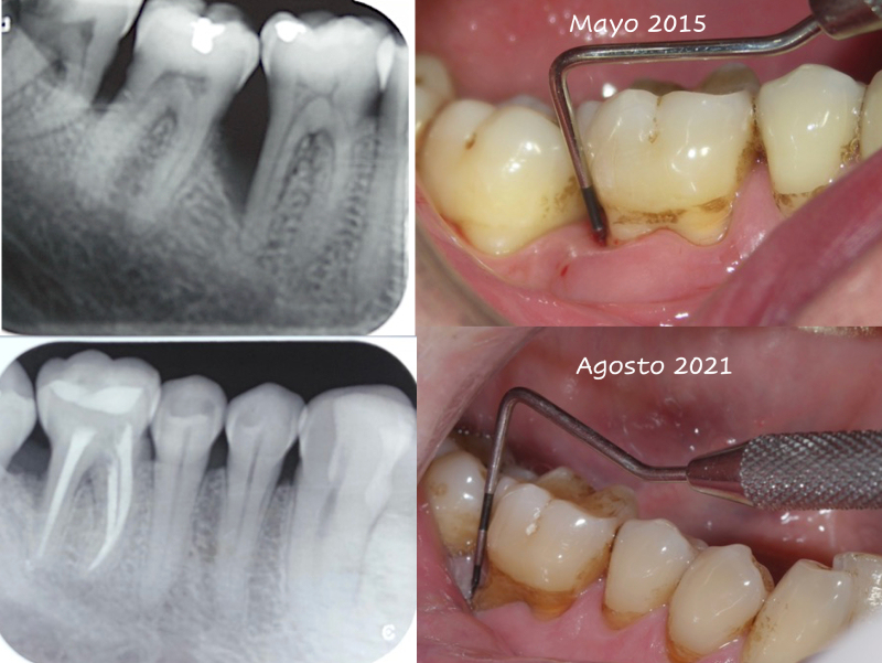 Láser en odontología