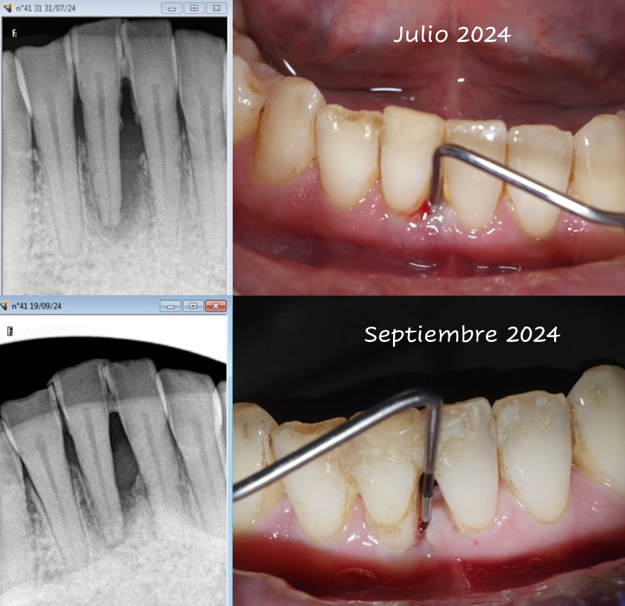 Láser en odontología